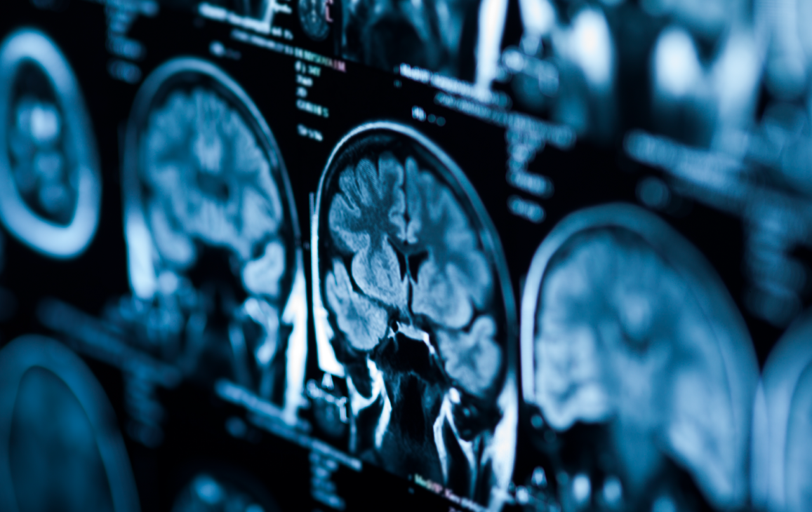 Brain & Skull-Base Tumors