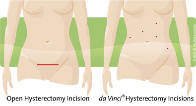 Illustration: hysterectomy incisions